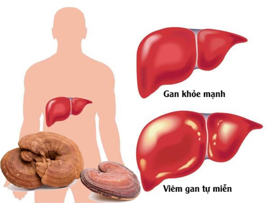 Nấm linh chi hỗ trợ điều trị bệnh viêm gan